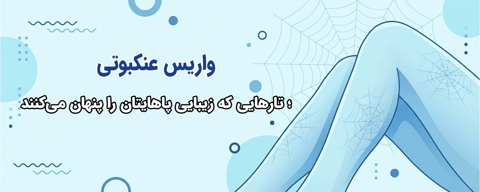 واریس عنکبوتی چیست و چرا به شکل رگ‌های ریز روی پا ظاهر می‌شود؟