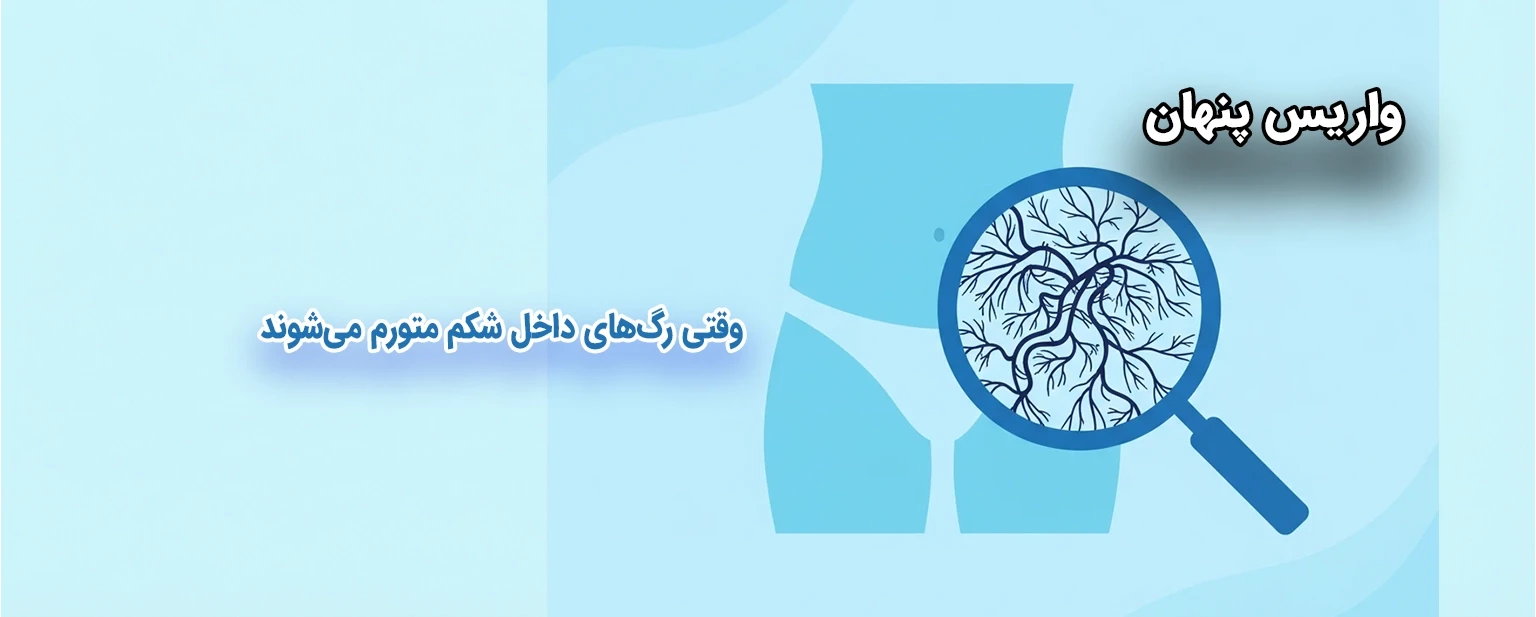 واریس لگن چیست و چرا معمولاً دیر تشخیص داده می‌شود؟