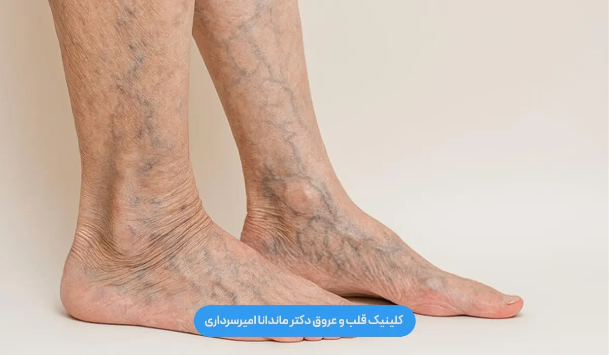 انواع واریس پا کدام‌اند و چه تفاوتی باهم دارند؟