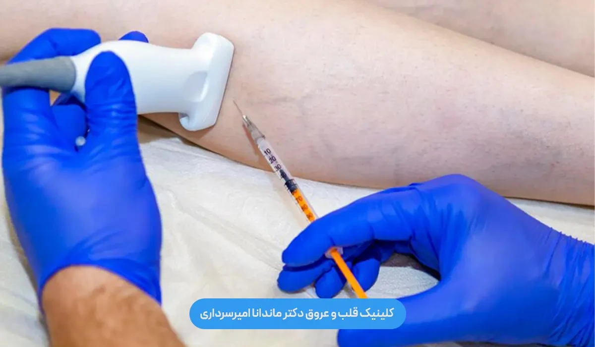 آیا واریس بعد از لیزر دوباره برمی‌گردد؟