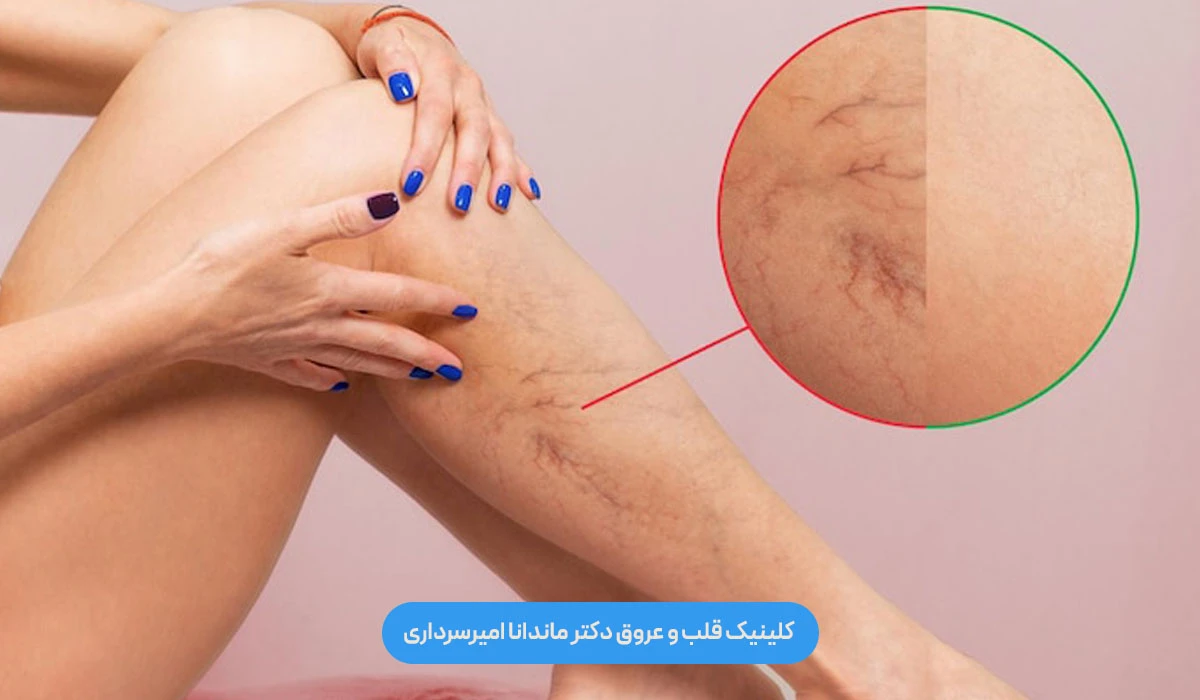 واریس عنکبوتی چیست و چرا به شکل رگ‌های ریز روی پا ظاهر می‌شود؟