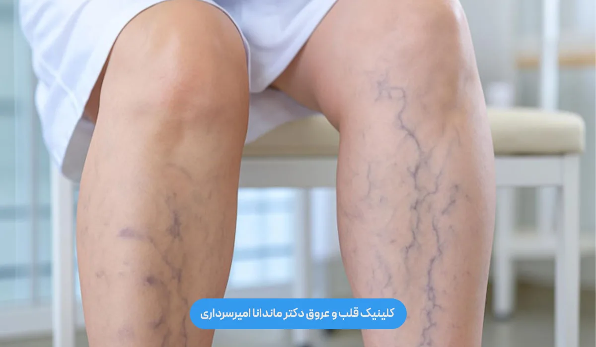 علائم واریس