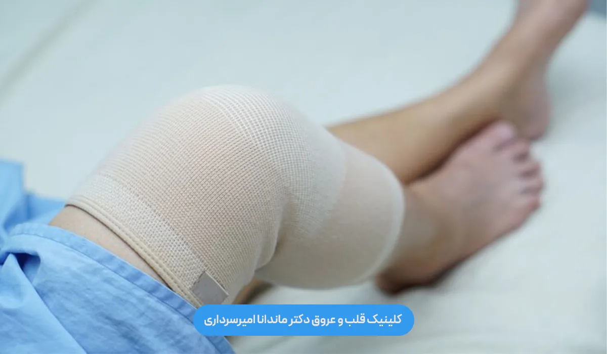 راهکارهای بعد از لیزر برای عدم بازگشت واریس