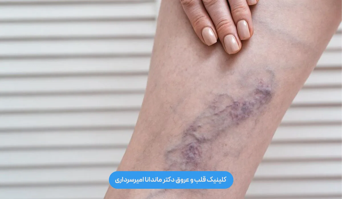 واریس پا از کجا شروع می‌شود؟