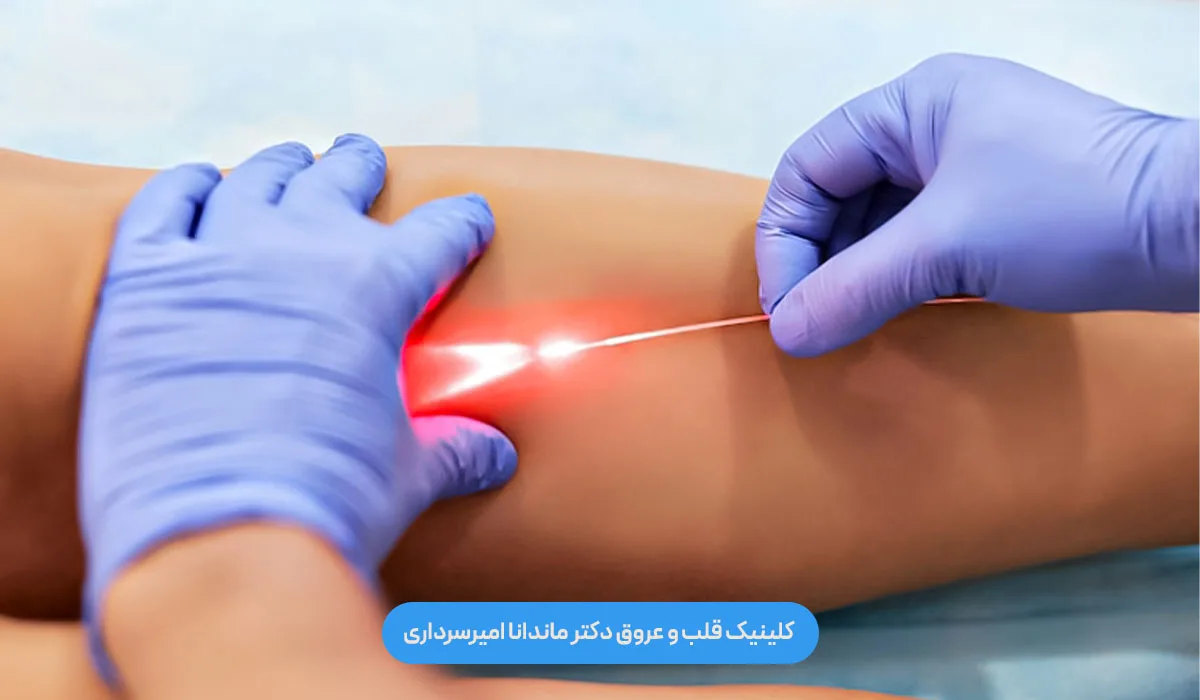 لیزر واریس