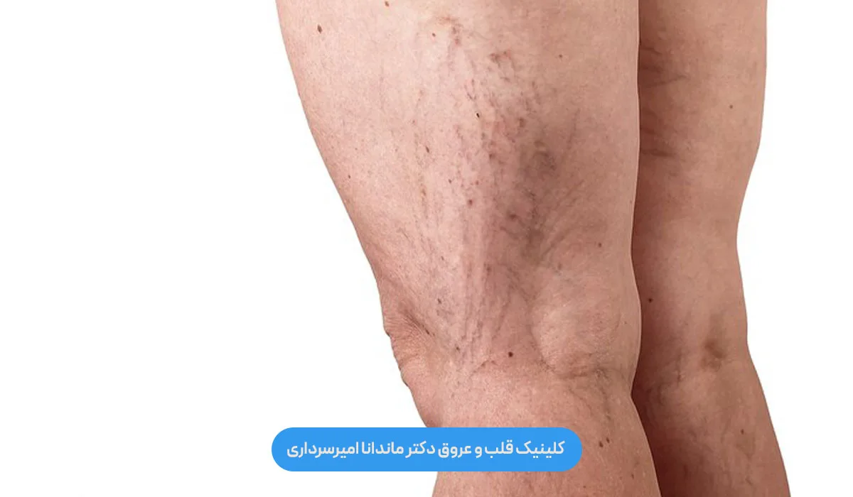 واریس پا چیست؟