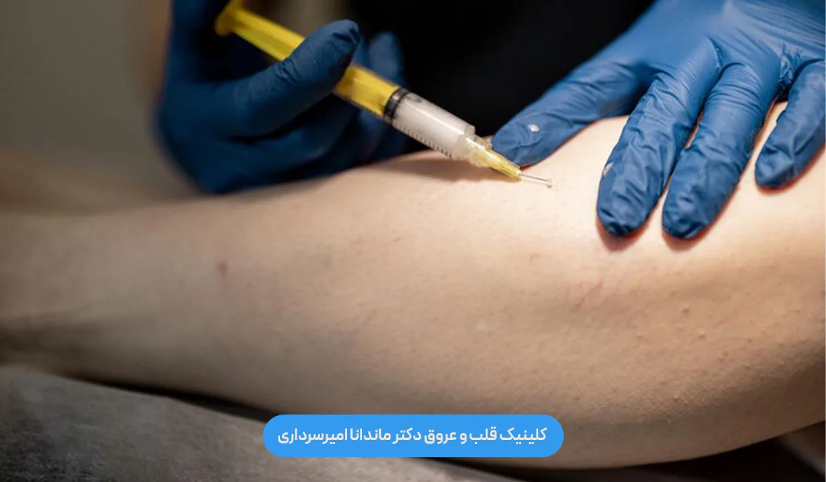 واریس عنکبوتی