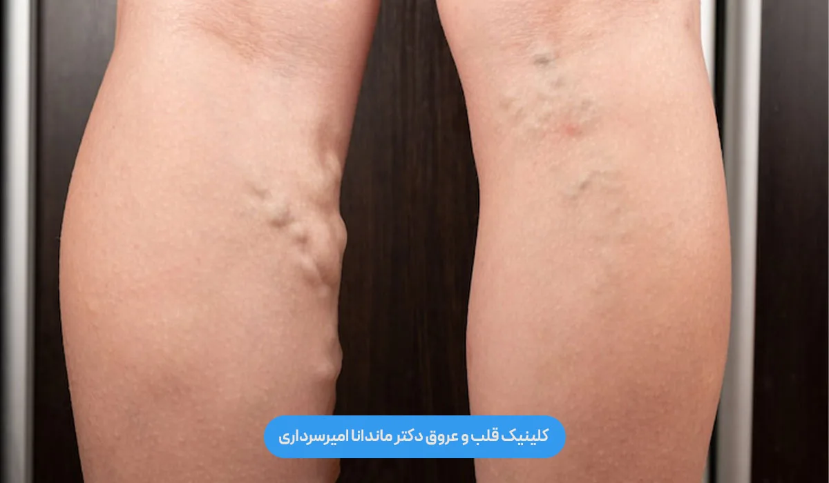 علت بازگشت واریس بعد از لیزر رگ چیست؟