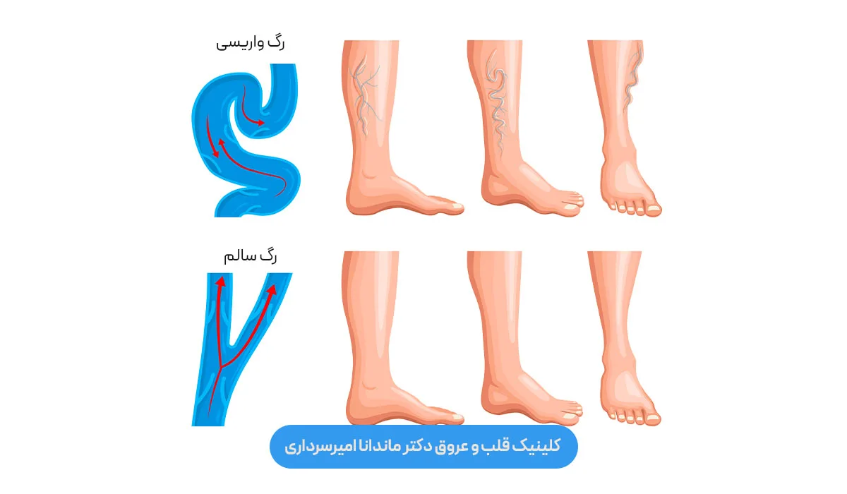 آیا واریس بعد از لیزر دوباره برمی‌گردد؟ 