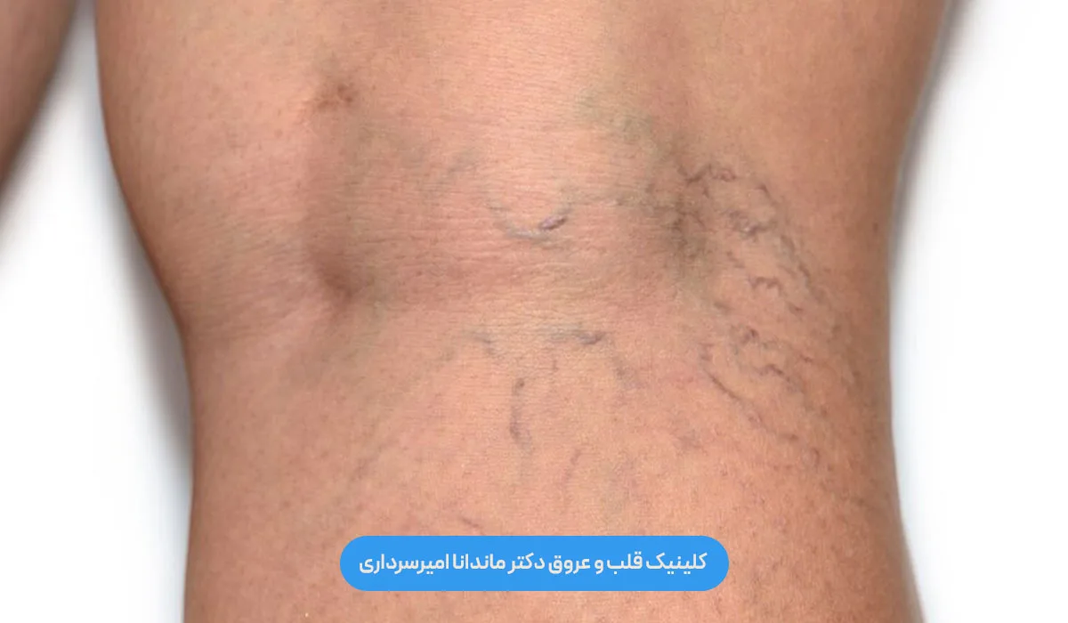 واریس پا از کجا شروع می‌شود،