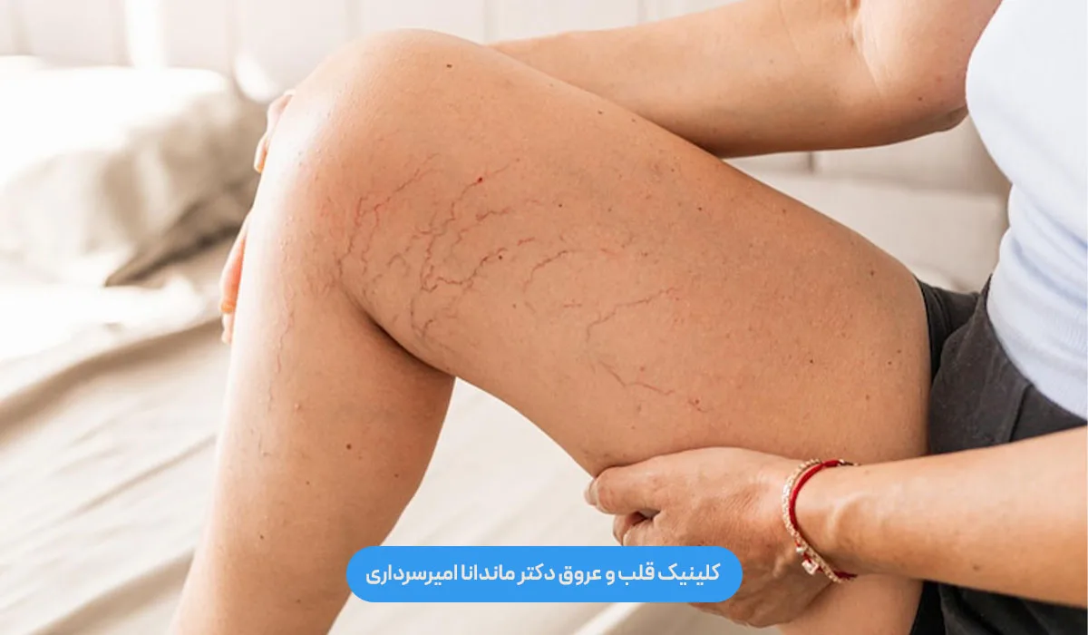 علل اصلی ایجاد واریس عنکبوتی